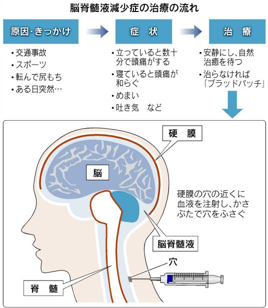 弁護士 小松亀一法律事務所 交通事故 脳脊髄液漏出症画像判定基準 画像診断基準紹介１